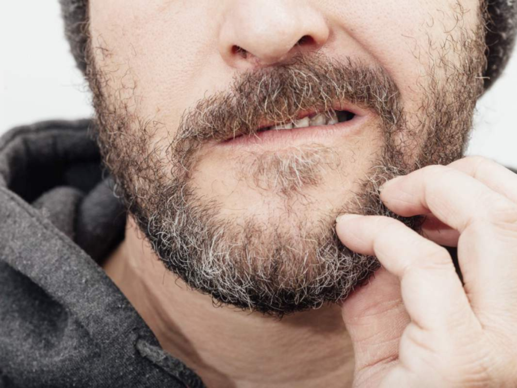 itchy beard