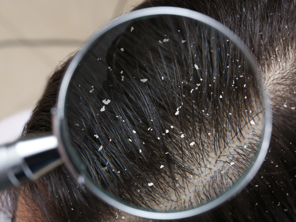 Understanding the Causes of Dry Hair and Scalp