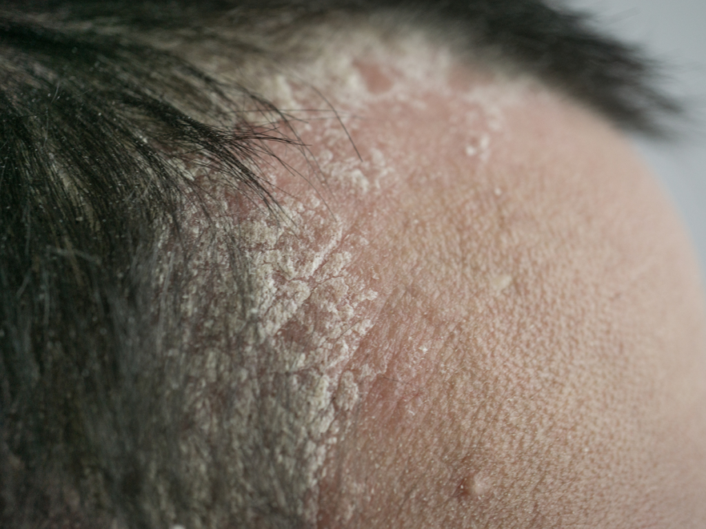 Health Conditions, Psoriasis